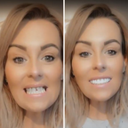 Dental Veneer Kit | Customizable, Easy Application & Ideal for At-Home Smile Makeover