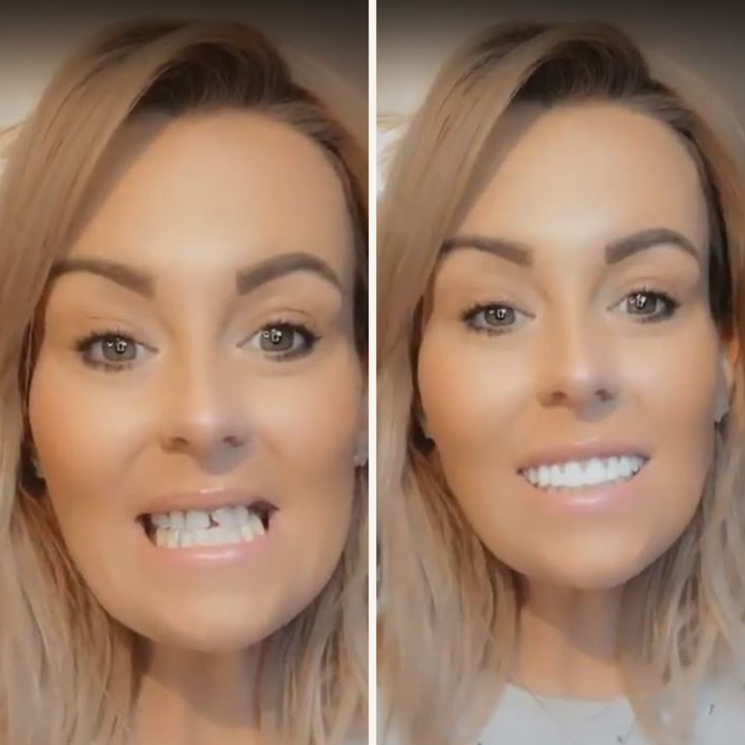 Dental Veneer Kit | Customizable, Easy Application & Ideal for At-Home Smile Makeover