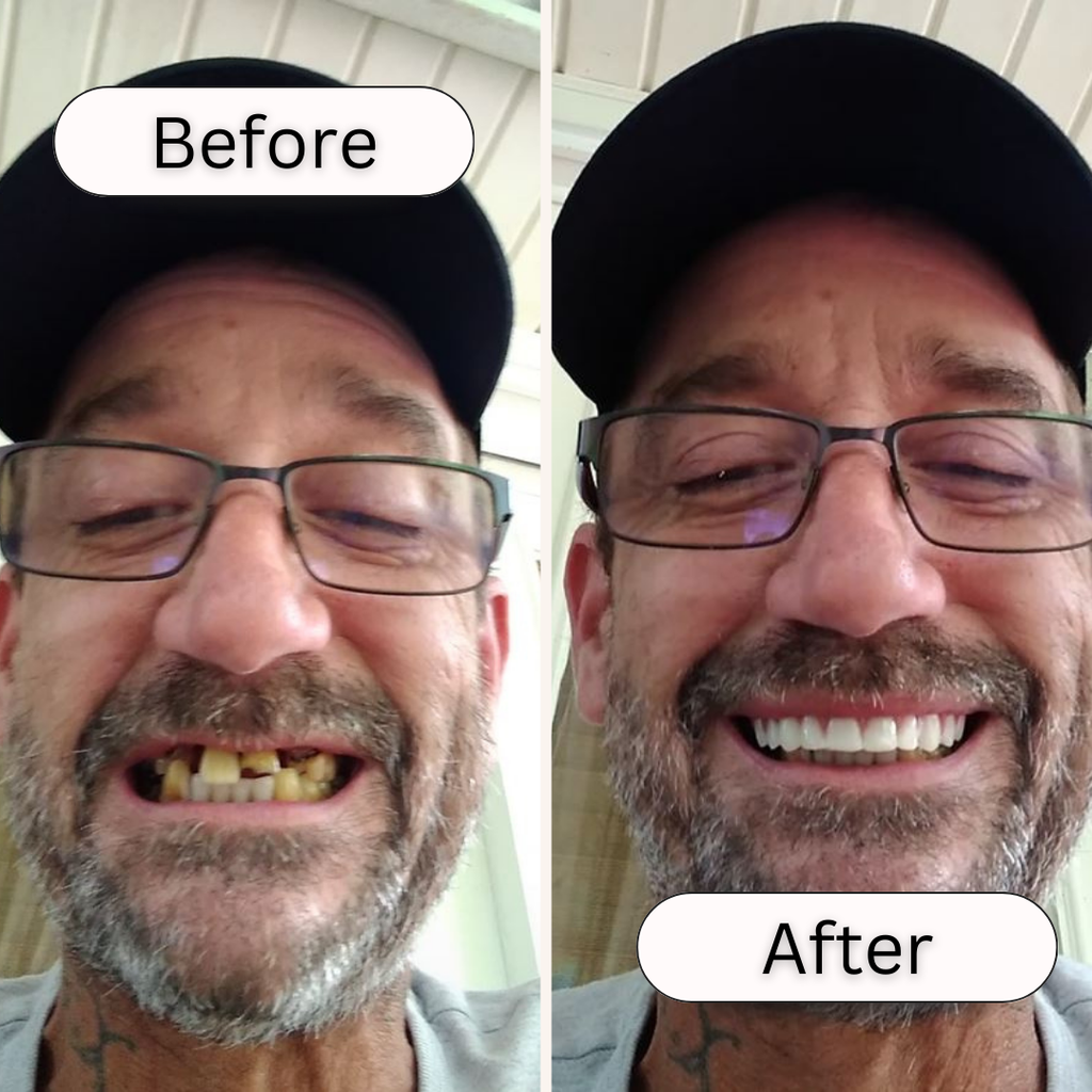 Dental Veneer Kit | Customizable, Easy Application & Ideal for At-Home Smile Makeover