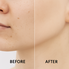 Picosecond Laser Pen - Dark Spot Removal Pen - Light Therapy Dark Spot Remover