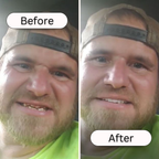 Dental Veneer Kit | Customizable, Easy Application & Ideal for At-Home Smile Makeover