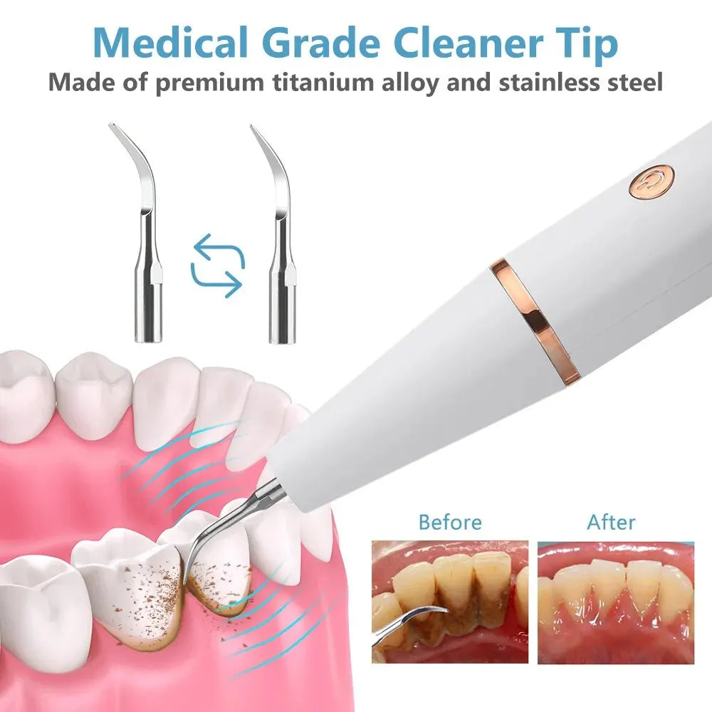 Ultrasonic Tartar Remover | 38 kHz, LED Light & USB Fast Charging for At-Home Dental Care