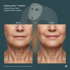 Ultra-Light 120g LED Phototherapy Mask | Deep Wrinkle Support for Aging Skin & Elderly Users
