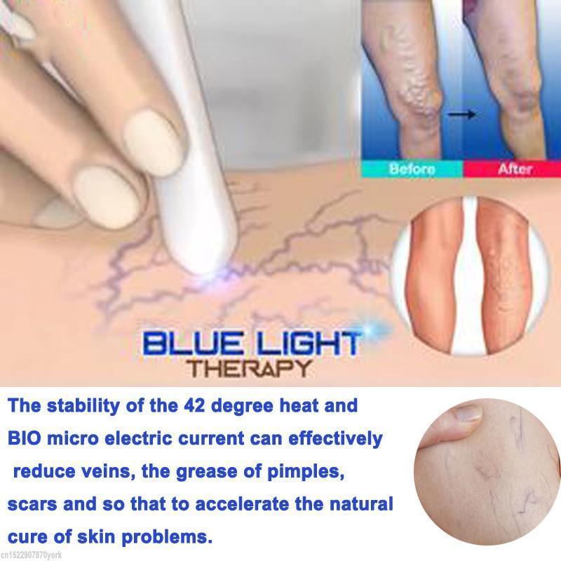 Spider Veins Removal Pen - Blue Light Therapy Laser Pen For Varicose Veins - Balma Home