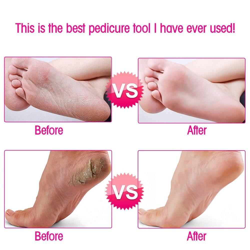 Callus Remover - Foot Callus Remover